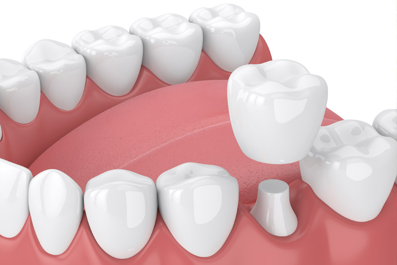Dental Crowns in Plaistow