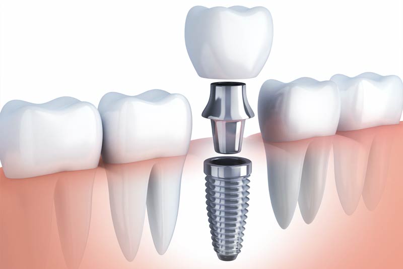 Implants Dentist in Plaistow