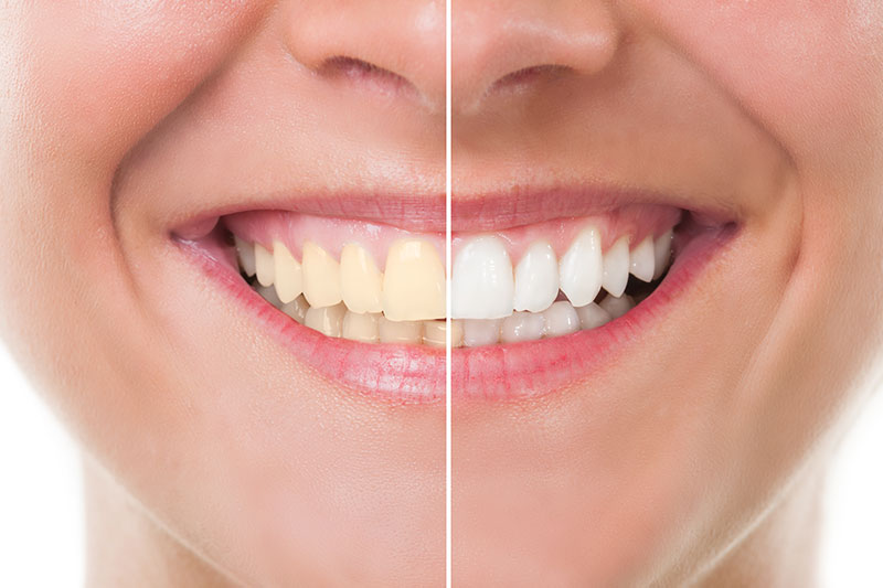 Teeth Whitening in Plaistow